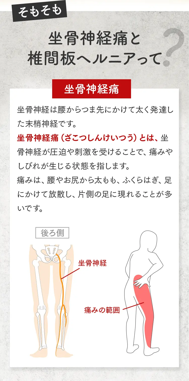 坐骨神経が腰から足先にかけて通っている様子と、お尻から太もも、ふくらはぎにかけての痛みが生じる範囲（赤い領域）を示した解剖図。