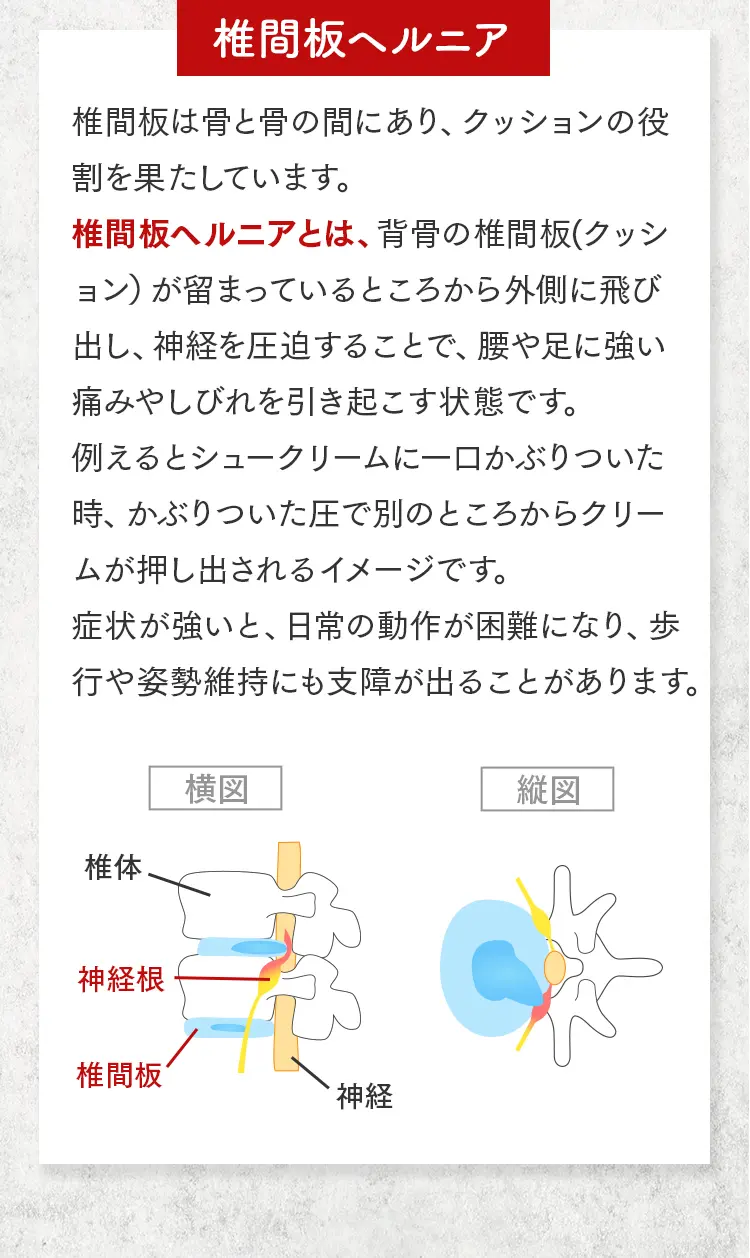 背骨の椎間板（クッション）が外側に飛び出し、神経根を圧迫している様子を横図と縦図で示した医学的イラスト。