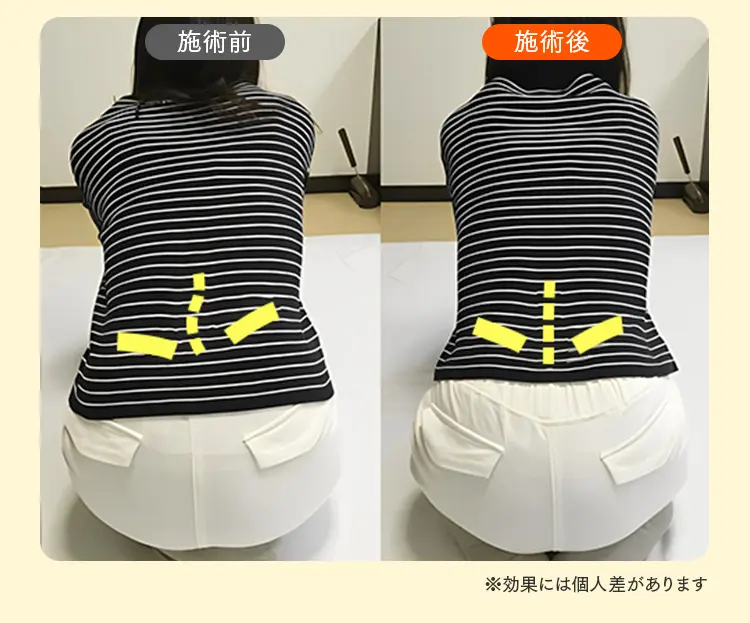 腰痛改善に向けた整体の施術前後比較。左右に歪んでいた骨盤のラインが整い、中心線が真っ直ぐになった状態。