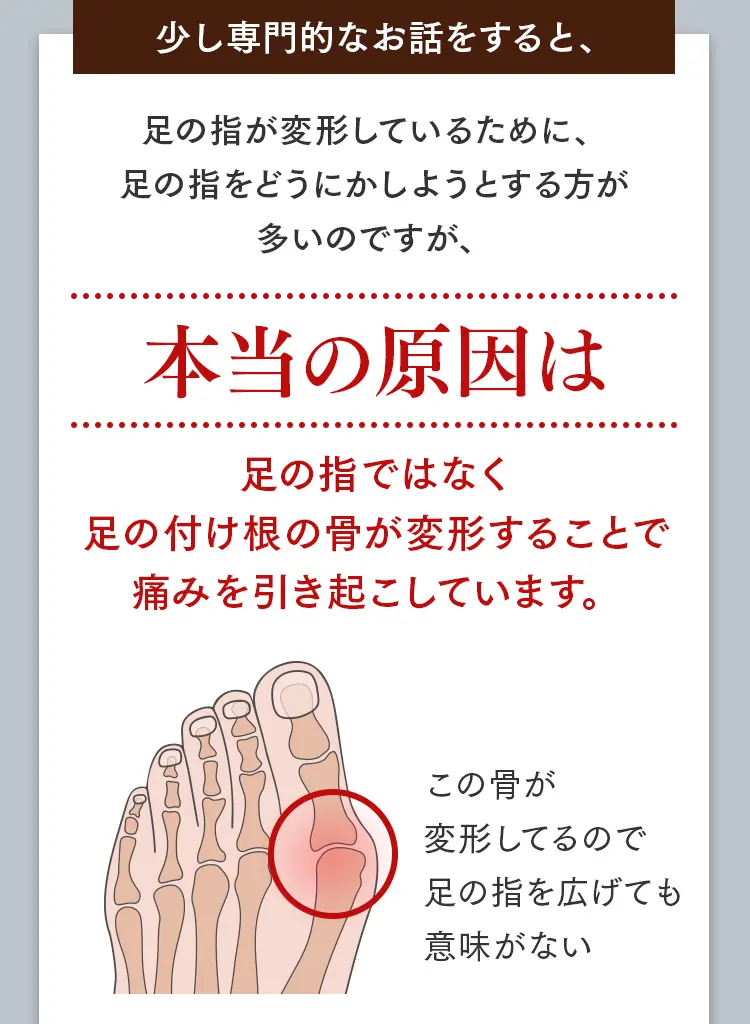 外反母趾の本当の原因は指ではなく、足の付け根の骨の変形。指を広げるだけでは意味がない理由の解説図。