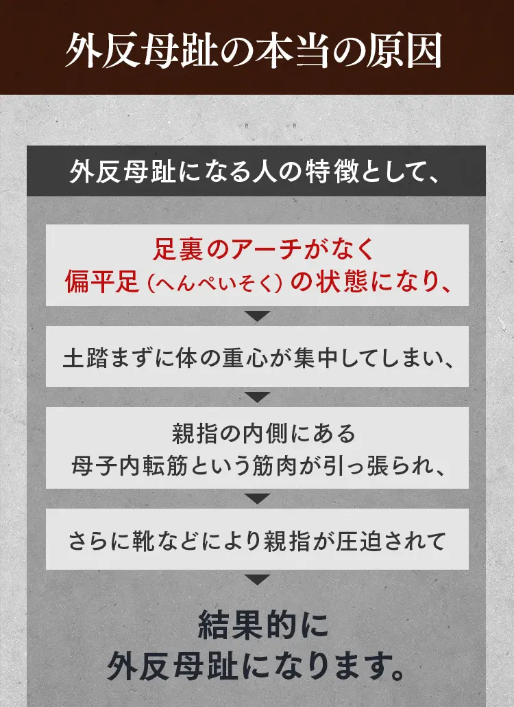 外反母趾のメカニズム：足裏のアーチがなくなり偏平足になることで重心が崩れ、母子内転筋が引っ張られるプロセス。